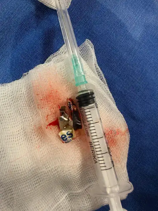 Ambalajıyla Yuttuğu Hap, 4 Yıl Sonra Akciğerinden Çıkarıldı 4